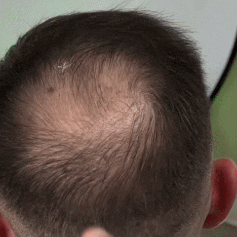 Animated red light scalp cap demonstration